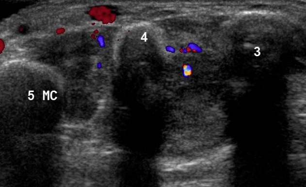 Figure 2 for case Plexiform schwannoma ( RID4480 )